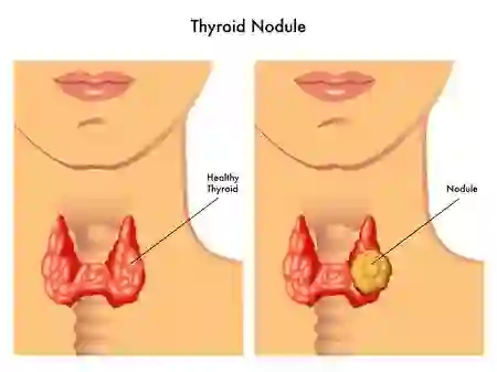  thyroid is a gland of Health: What to eat and what not to eat in thyroid? learn everything..